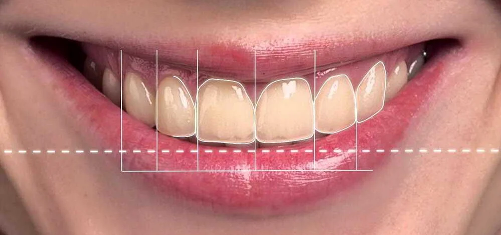 Основные процедуры эстетической стоматологии