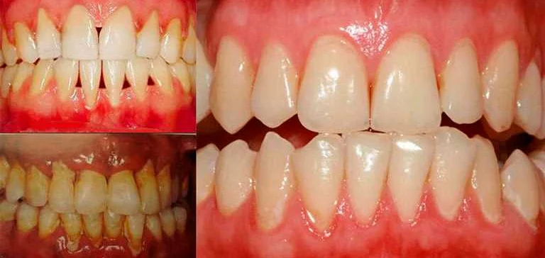 Профилактика пародонтоза periodontal-disease-prevention