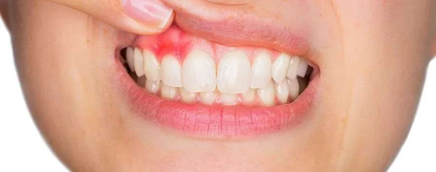 Ослабление зубов