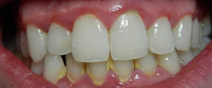 Избегайте привычек, которые усиливают зубную чувствительность