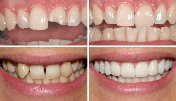 Избегайте потребления продуктов, которые ставят эстетическое состояние зубов под угрозу