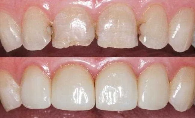 Способы сохранить эстетическое состояние зубов после процедур