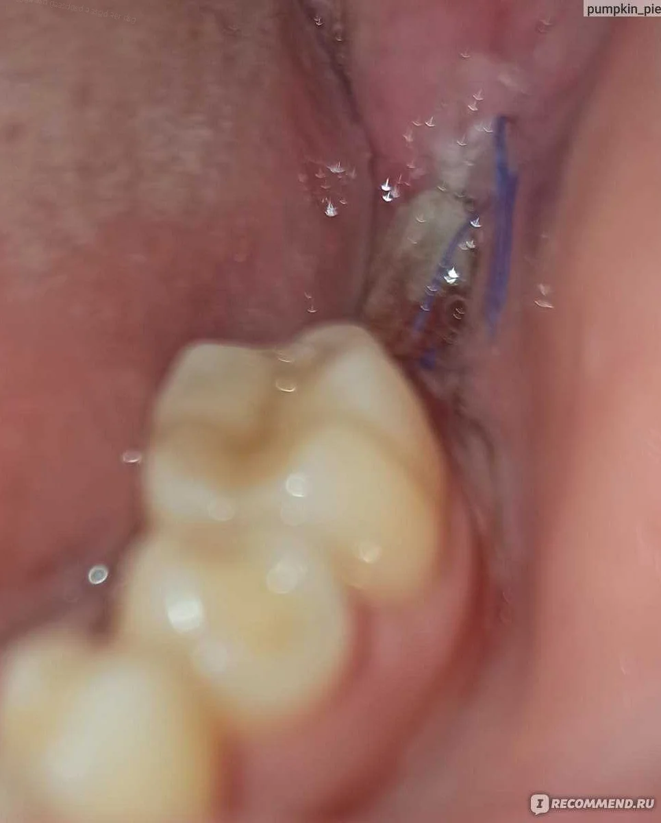 Белый налет после удаления зуба: фото и способы его устранения