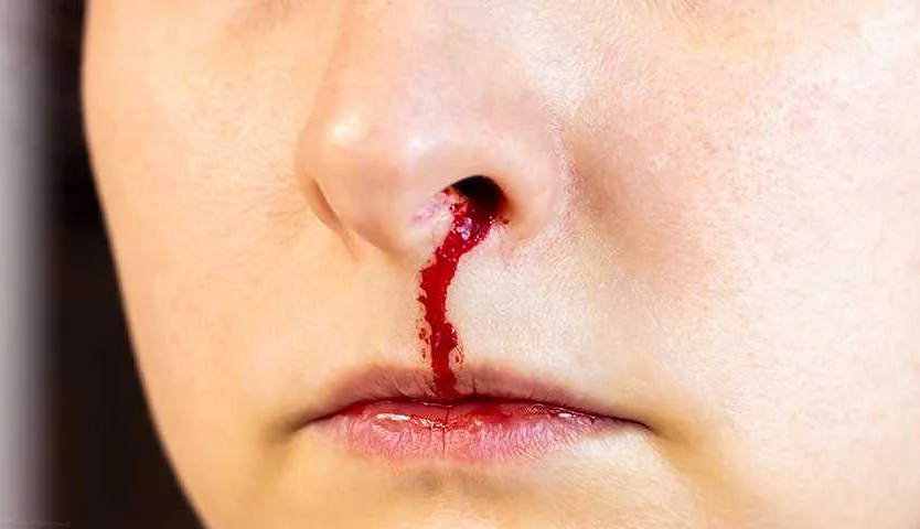 Как предотвратить носовые кровотечения?
