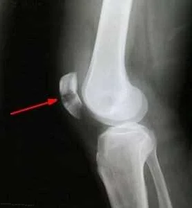Профилактика боли в колене после перелома
