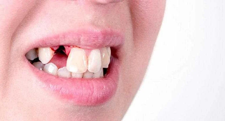 Как правильно ухаживать за раной после удаления зуба