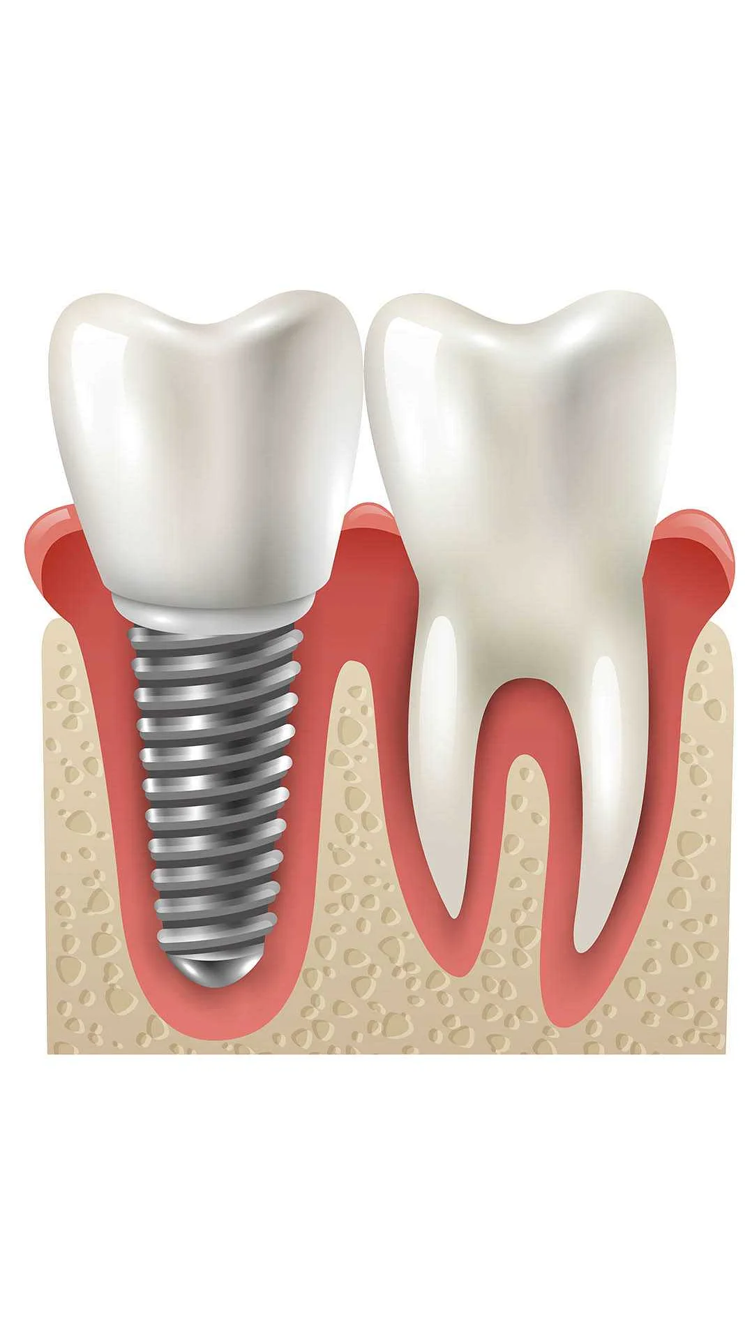Как правильно выбрать стоматолога и клинику для имплантации зубов?