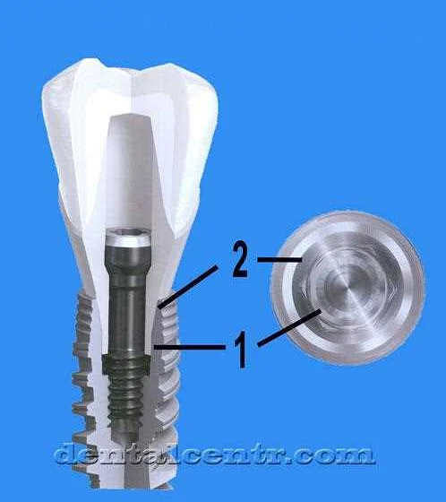 Основные рекомендации по уходу за зубными имплантами
