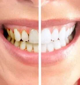 Гигиена после еды: основные рекомендации для здоровых зубов
