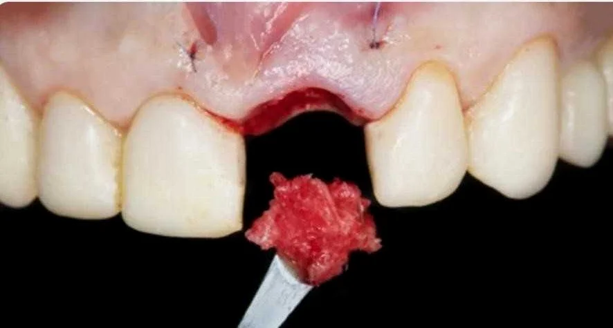 Соблюдение гигиены полости рта