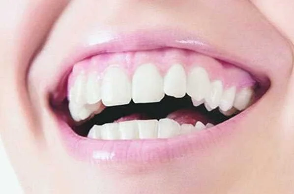 Что такое гуммированный смайл и как его исправить с помощью эстетической стоматологии
