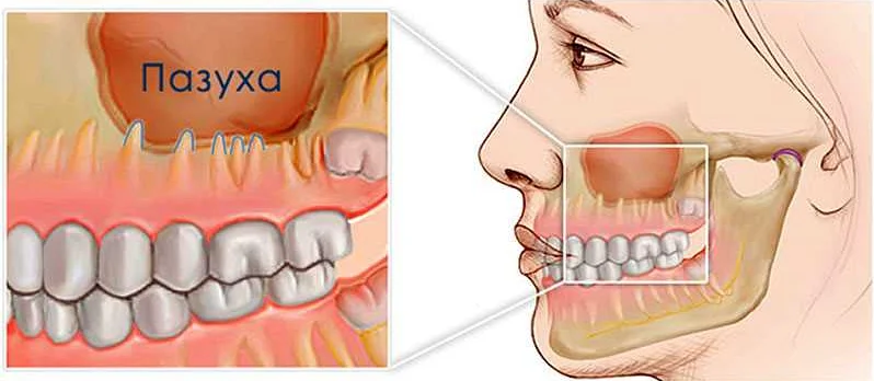 Синус-лифтинг: процедура восстановления зубов в верхней челюсти