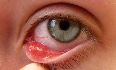 Какие профилактические меры могут предотвратить двоение в глазах и дискомфорт в глазном яблоке
