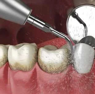 Выравнивание зубов: устранение причин возникновения пародонтоза