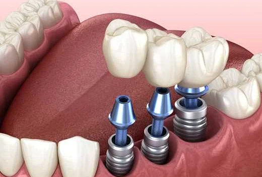 Основные проблемы эндокринологического протезирования зубов