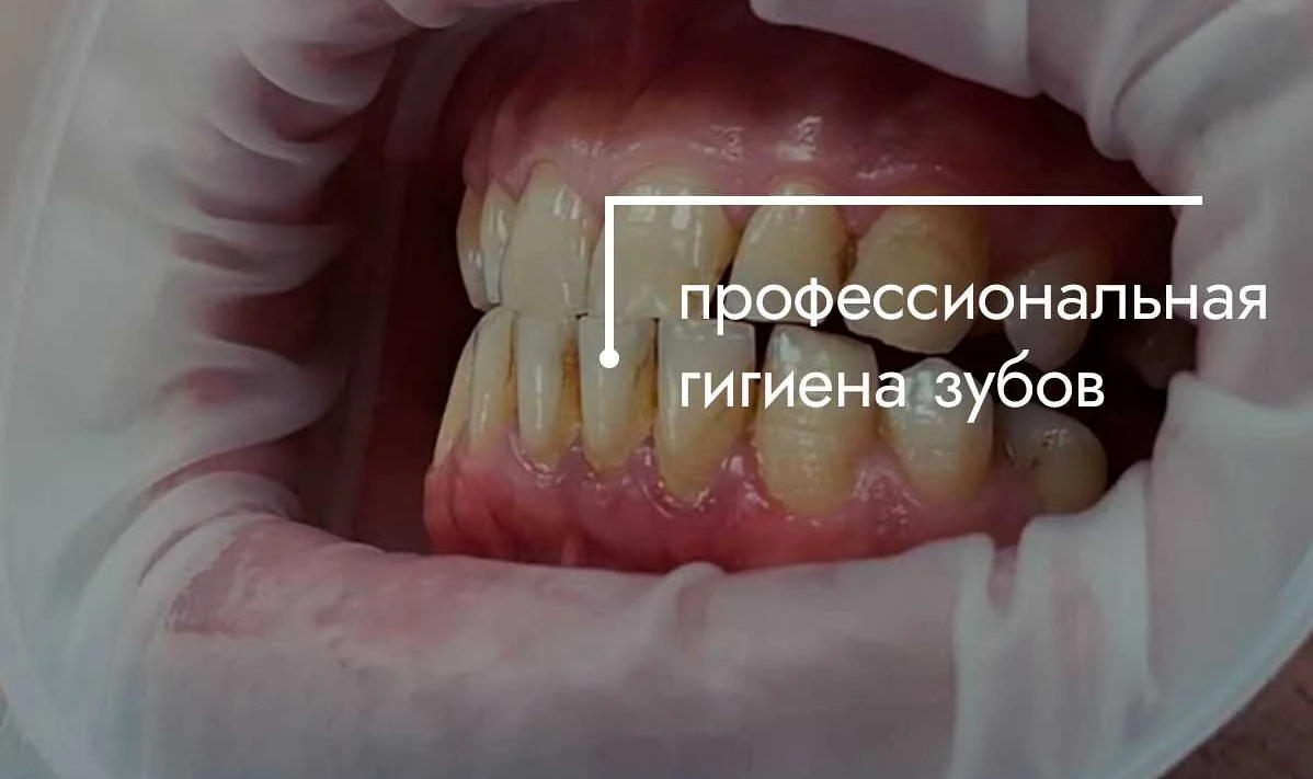 Использование зубной нити и ополаскивателей