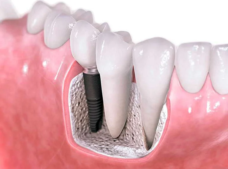 Гигиена зубов: 5 популярных методов и как выбрать самый эффективный