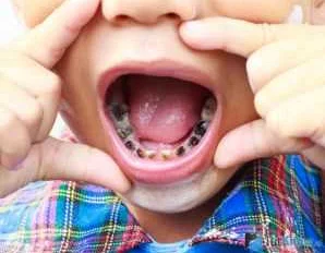 2. Научите ребенка правильной технике чистки зубов