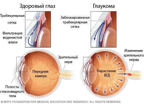Методы лечения глаукомы глаза