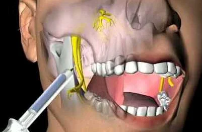 Процесс удаления зубов с глубокой анестезией