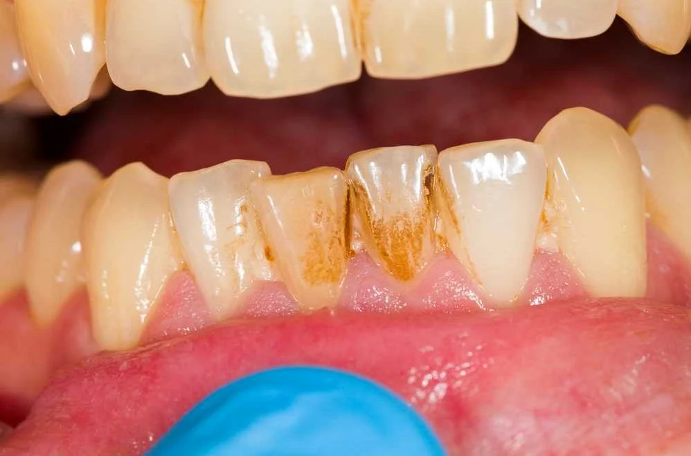 Роль гормонов в формировании зубной системы и ее нарушения