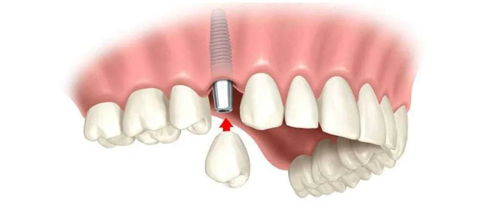 Протезирование и альтернативные методы восстановления зубов