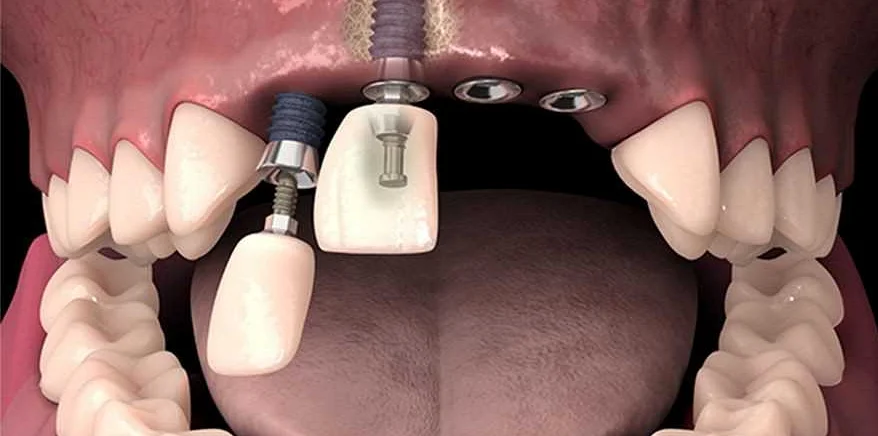Роль имплантологии в стоматологии