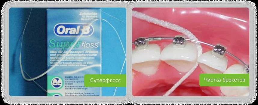 Рекомендации по использованию зубной нити с брекетами или имплантатами