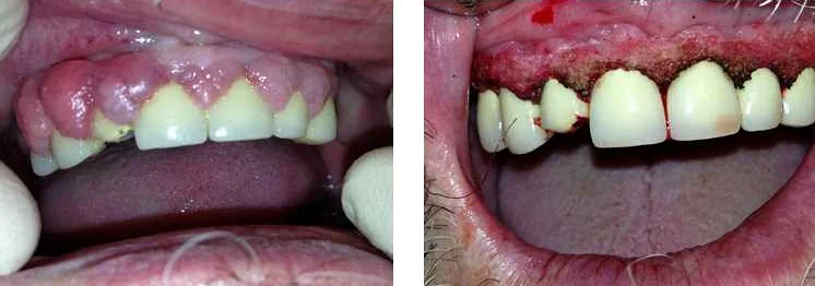 Уход после удаления зубов: рекомендации специалистов