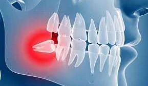 Процедура удаления зубов: важные моменты