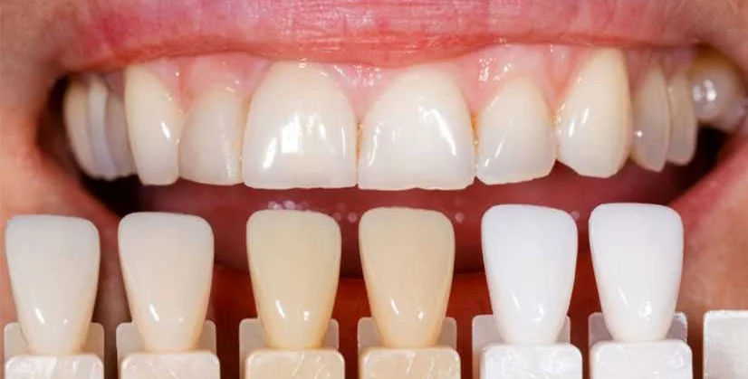 Советы по выбору цвета виниров для различных типов зубов