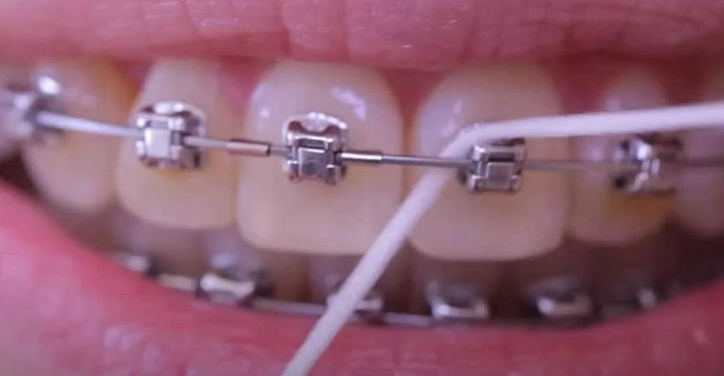 Почему использование зубной нити важно для поддержания гигиены