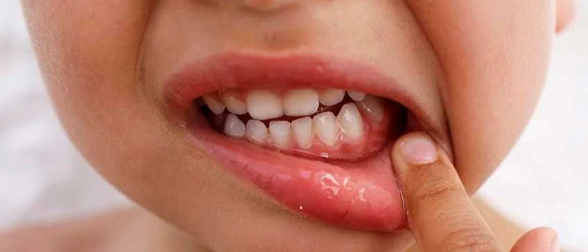 Профилактика травм полости рта