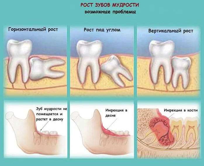 Удаление зубов: шаг за шагом