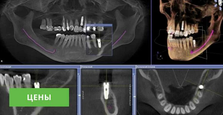 Применение рентгеновского аппарата для съемки челюсти