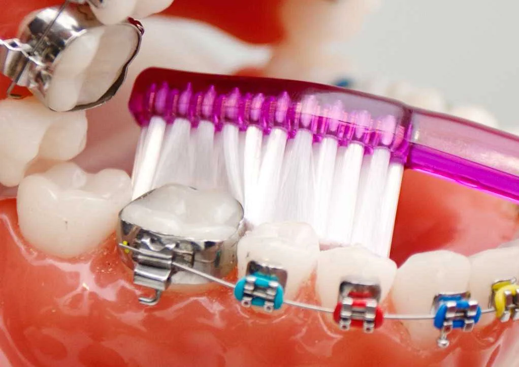 Периодический уход и контроль у ортодонта