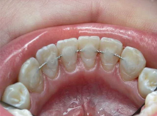 Какие симптомы могут быть при травме зубов