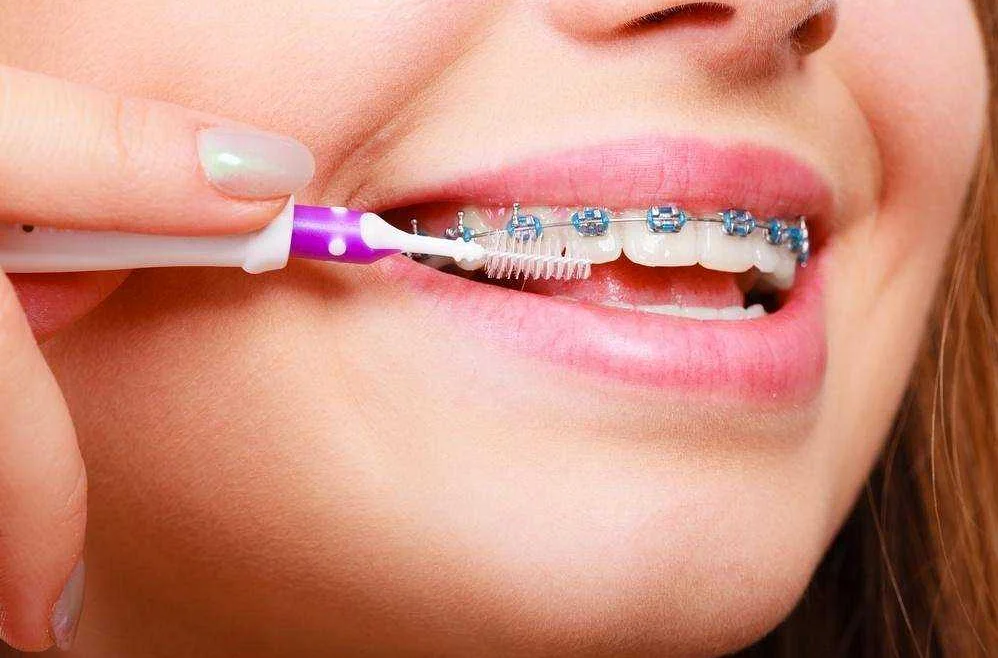 Как правильно ухаживать за зубными аппаратами во время ортодонтического лечения