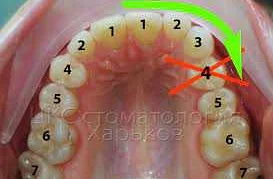 Металлический ортодонтический брекет: особенности и преимущества