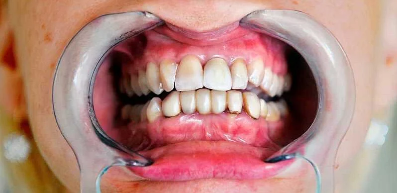 Регулярные посещения стоматолога