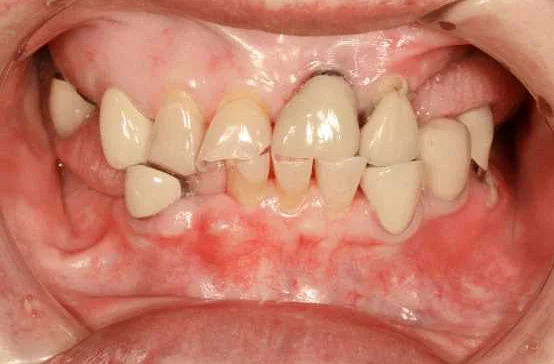 Роль профилактической чистки зубов в предотвращении пародонтоза