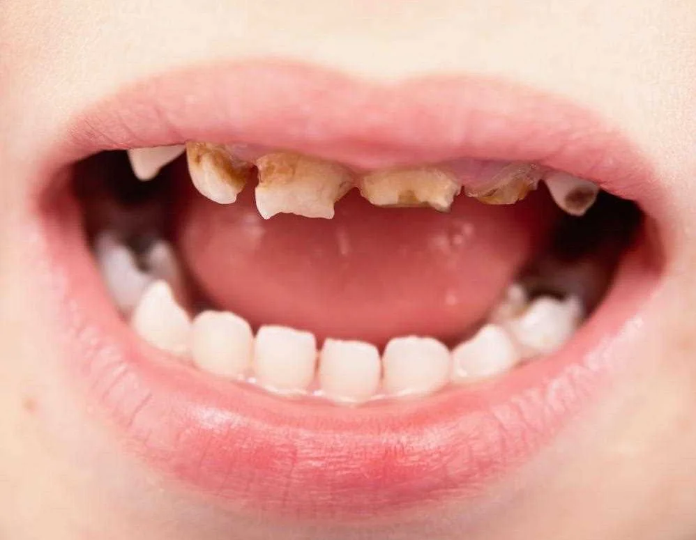 Укрепление эмали зубов у ребенка