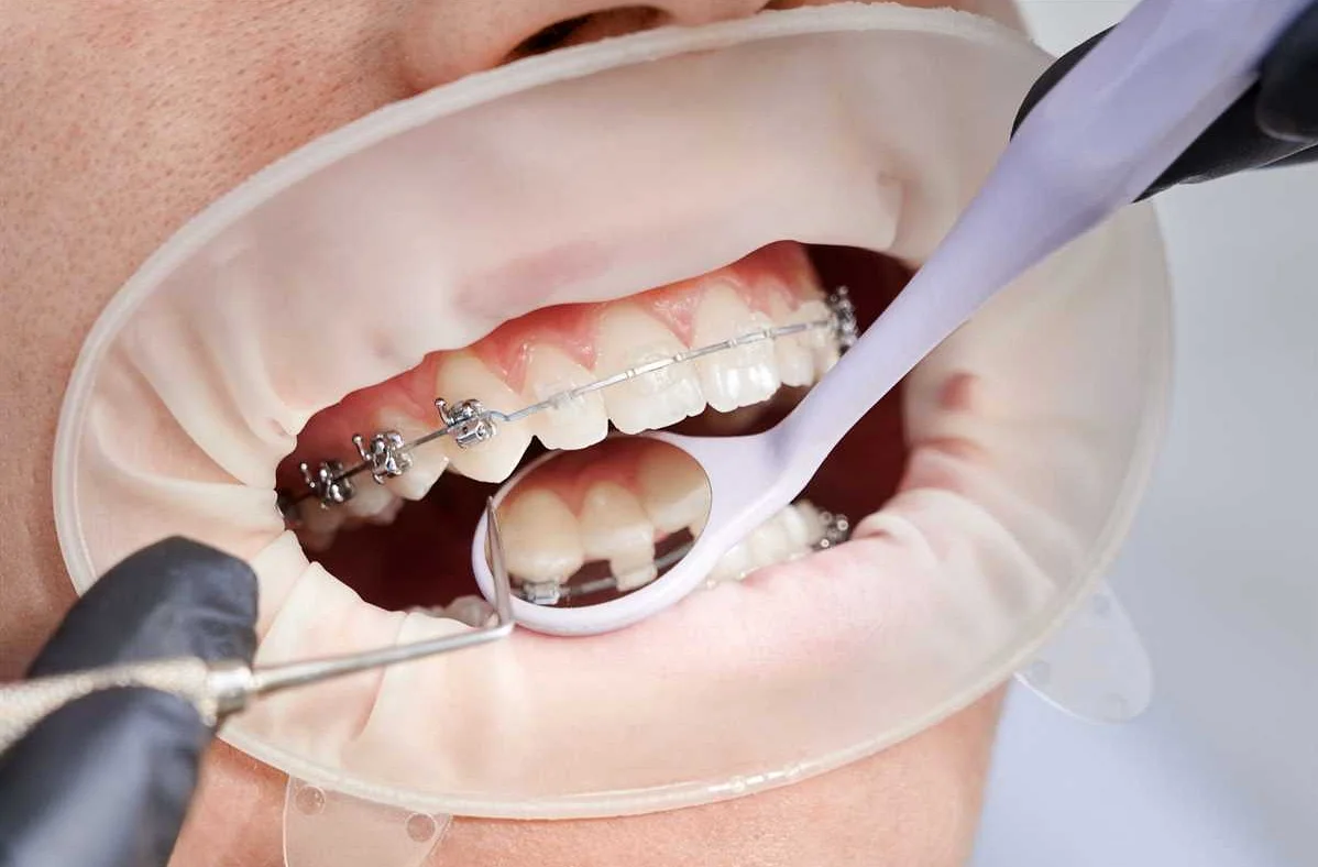 Необходимость своевременного визита к ортодонту для предотвращения болезней полости рта