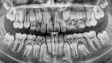 Сравнение разных типов снимков челюсти для диагностики травмы зубов