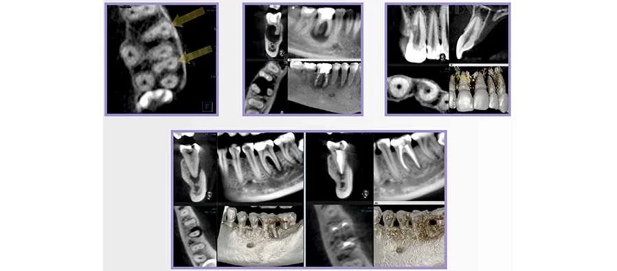 Преимущества использования компьютерной томографии для диагностики травмы зубов