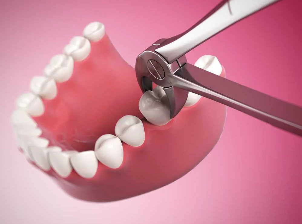 Укрепление десен после удаления зубов: важные моменты и рекомендации