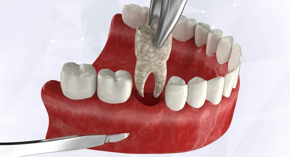 Влияние удаления зубов на состояние десен