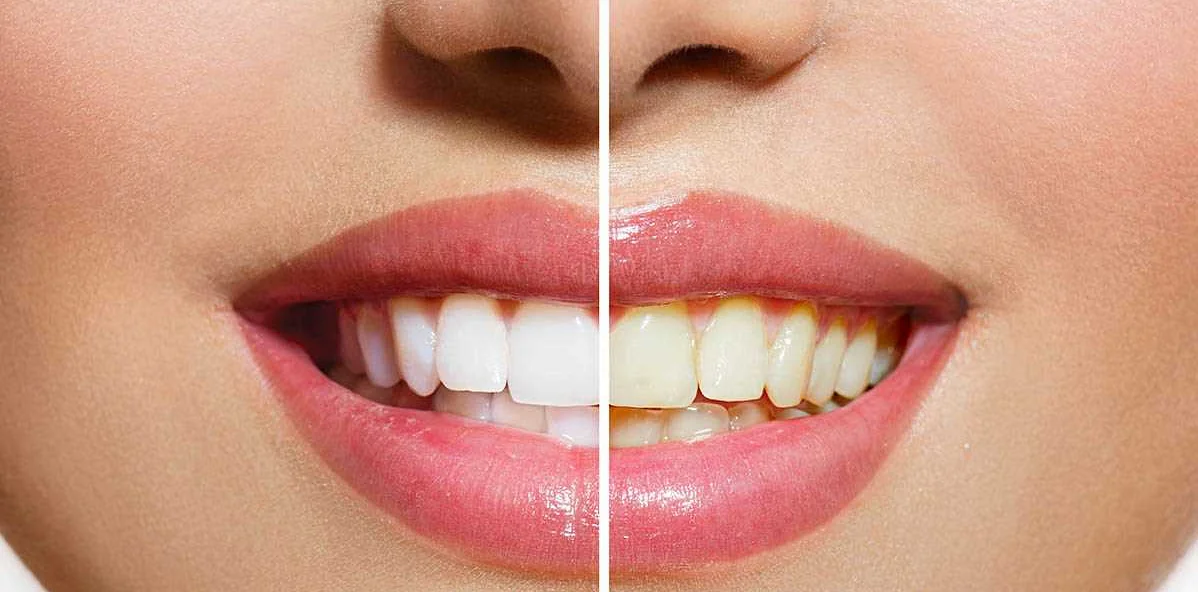 Как сделать улыбку белоснежной: новые методы отбеливания зубов