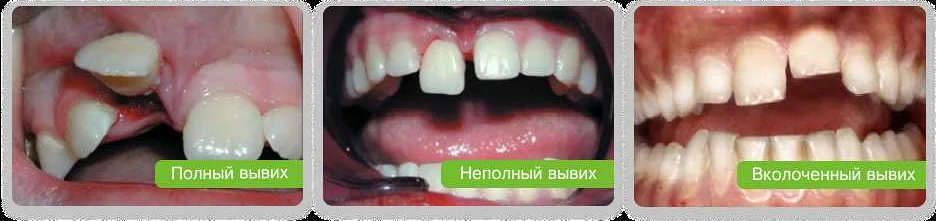 Реабилитация после травматических повреждений зубов