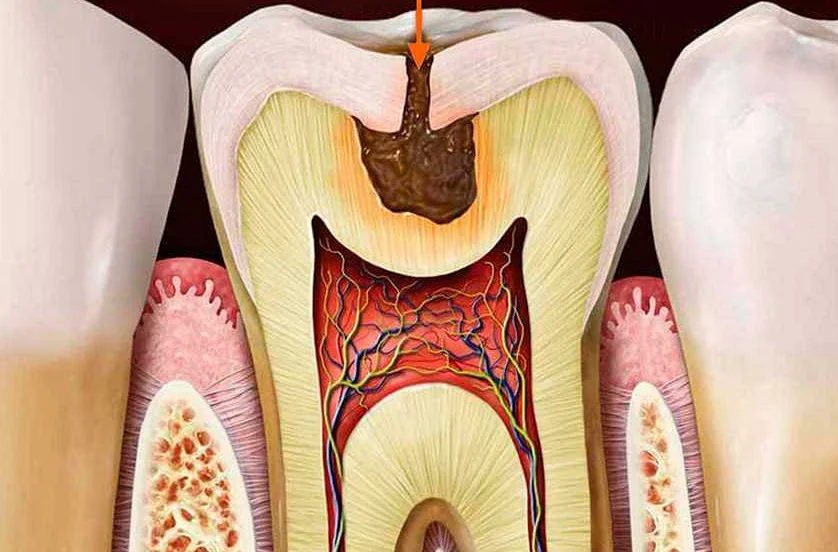 Потенциальные проблемы при плохом состоянии зубов